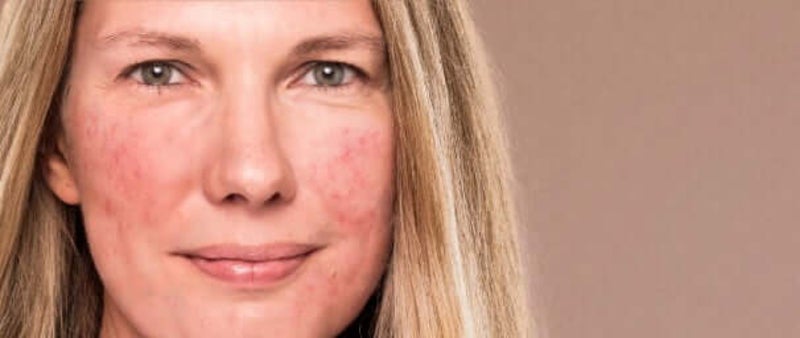 Blonde middle aged woman with rosacea