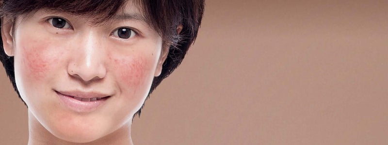 Asian woman with rosacea