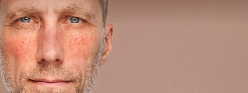 Middle aged man with rosacea