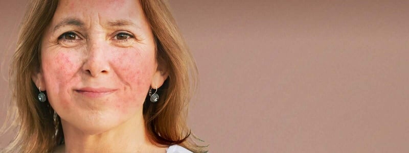 Woman with rosacea