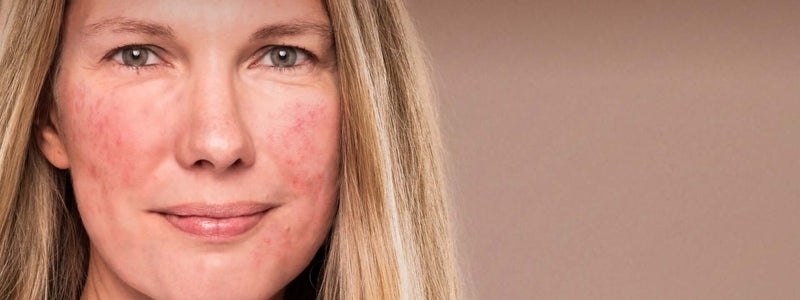 Blonde middle aged woman with rosacea