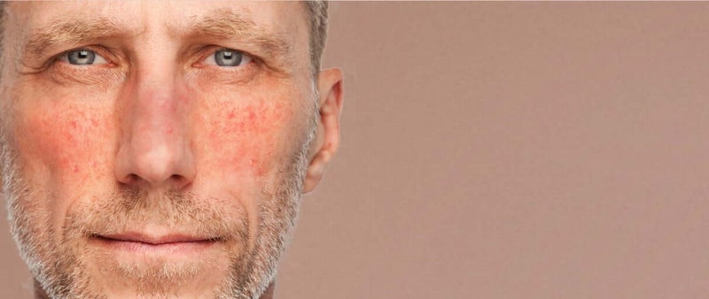 Middle aged man with rosacea